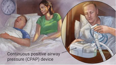 Sleep Apnea