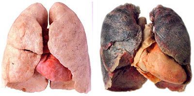 lung cancer